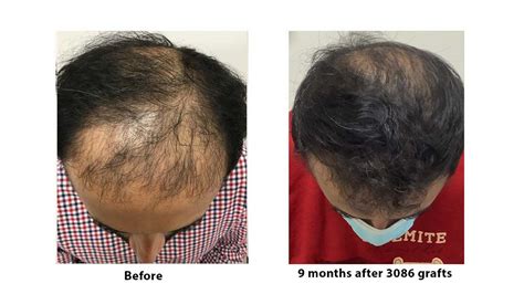 Artas Hair Transplant Cost India Annalisa Bolt