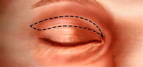 Como E Feita A Cirurgia De Palpebras Caidas Livros