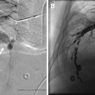 A A Digital Subtraction Angiogram Of The Right Pulmonary Artery