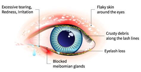 Blepharitis - Eyecare Virginia Beach