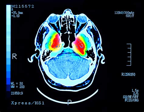 Parkinson la detección temprana es clave para el tratamiento adecuado