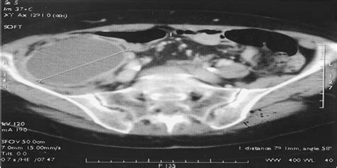 The Clinical Spectrum Of Retroperitoneal Hematoma In Anticoa Medicine