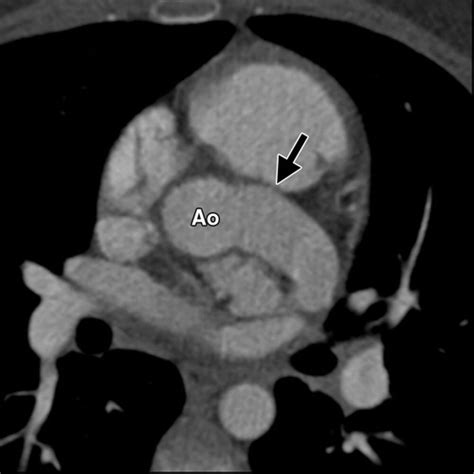 Coronary Artery Aneurysms And Ectasia Role Of Coronary CT Angiography