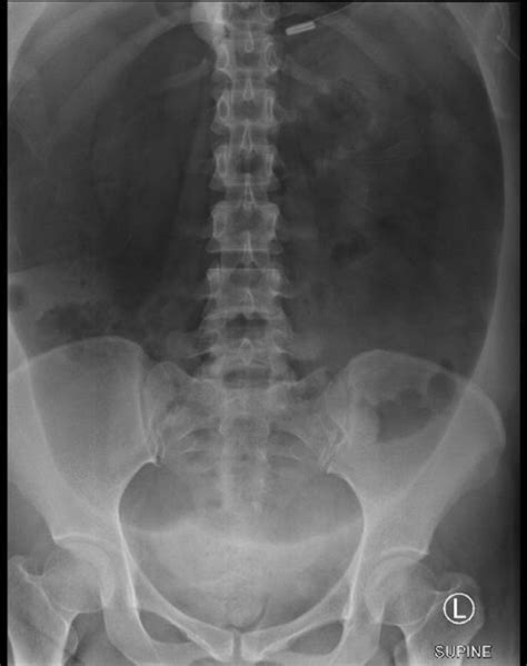 Abdominal Radiograph Shows Large Lucency Suspicious Of A Football Sign