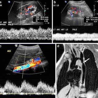 Parvus et tardus waveform appearance in a 16-year-old girl. a ...