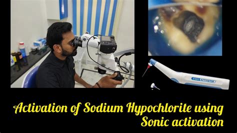 Sodium Hypochlorite Activation Using Sonics Champagne Bubble Test In