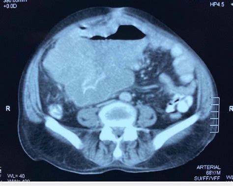 Ct Scan Of The Upper Pelvis Showing A Large Gastrointestinal Stromal