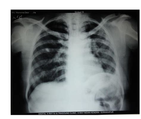 Chest Roentgenogram Showing Bilateral Regressing Stable Koch S Lesion