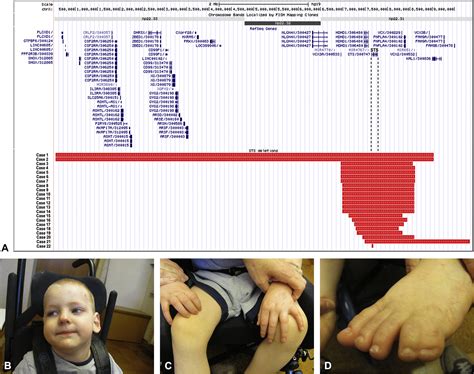 The Phenotype Spectrum Of X Linked Ichthyosis Identified By Chromosomal Microarray Journal Of