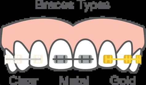 Braces for Gap Teeth: Orthodontic Patient Guide for Gapped Teeth