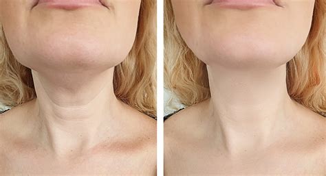 Neck Botox The Procedure Risks Aftercare And Benefits Vibrantskinbar