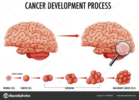 Diagrama Que Muestra Cerebro Humano Ilustración Del Cáncer Vector De