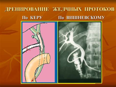 Острый холецистит - презентация онлайн