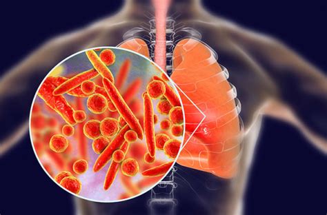 Mengenal Gejala Pneumonia Yang Perlu Diwaspadai Begini Cara