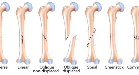 Common Fractures Mmd Chiropractic Health Centre