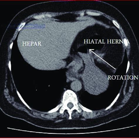 CT scan showing huge hiatal hernia and upside-down stomach. | Download Scientific Diagram