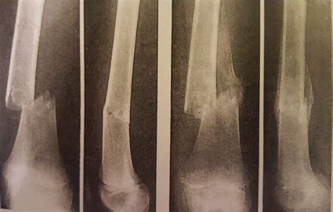 Pathology Of Fractures And Fracture Healing Momentum