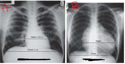 Chest Radiograph Practice Integration Flashcards Quizlet