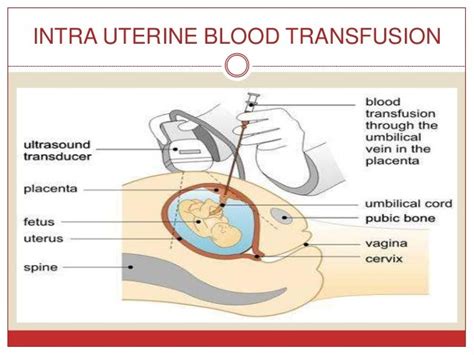 Fetal Therapy