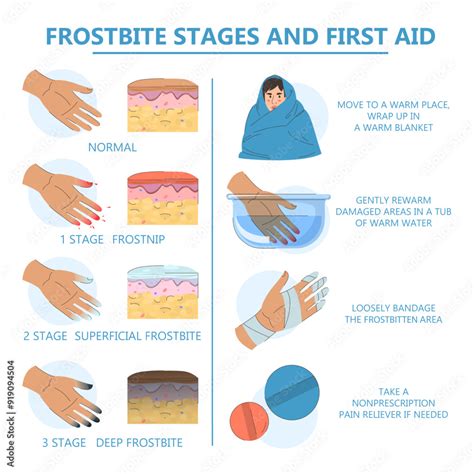 Frostbite Infographic Vector Isolated First Aid And Stages Of