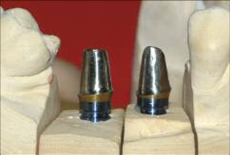 The Premachined Abutments Were Prepared And Finished On The Implant Lab Download Scientific