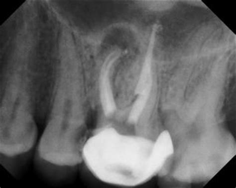 Root Canal Retreatment Case Portfolio | Advanced Endodontics of Connecticut | The Root Canal ...