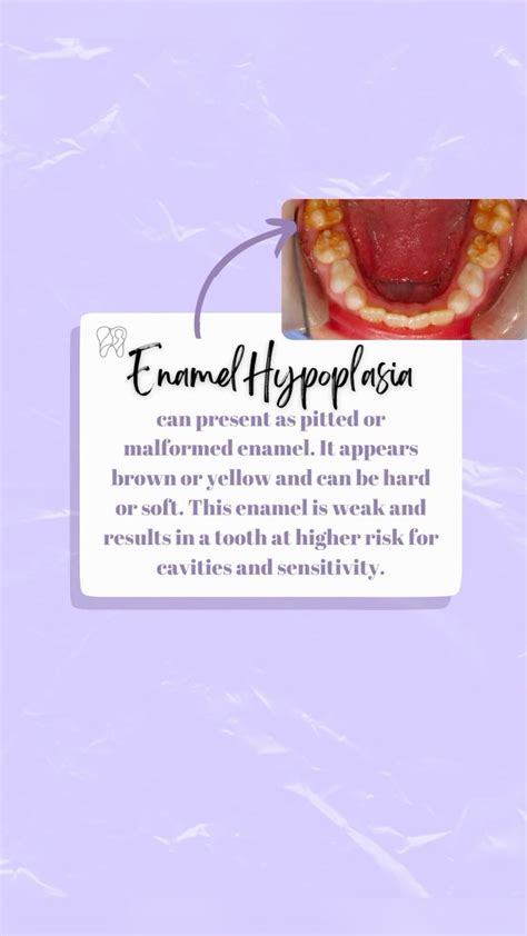 What Is Enamel Hypoplasia?