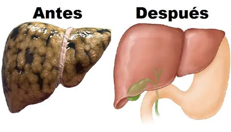 Cómo regenerar el hígado de manera natural y sanarlo CONSEJOS