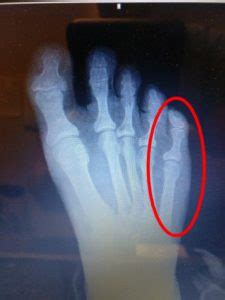 Sprained Pinky Toe or Broken Pinky Toe? [Diagnosis & Best Treatment!]