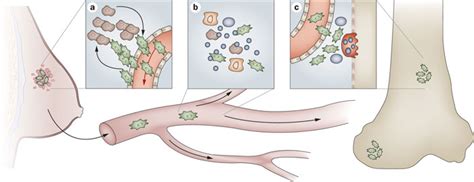 Steps Involved In Tumor Cell Metastasis From A Primary Site To The