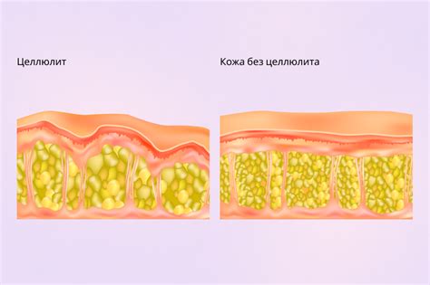 chto takoe tsellyulit  nuzhno li ego lechit goryashchaya izba