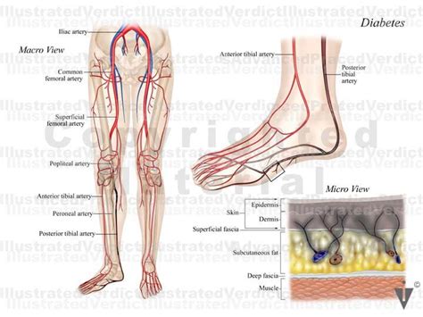 Stock Lower Limb Clots Plaques In Vasculature Illustrated Verdict