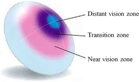 Monovision Multifocal