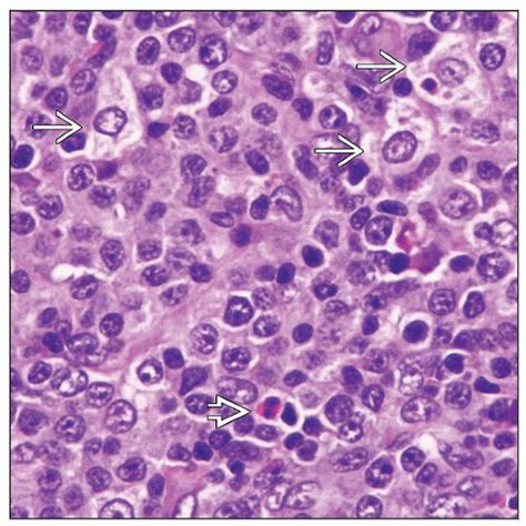 Peripheral T Cell Lymphoma Not Otherwise Specified Basicmedical Key