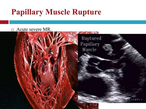 Echocardiographic Evaluation Of Mitral Valve Disease Mitral