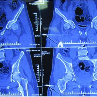 Computed Tomography CT Scan Of The Right Hip Coronal Section CT Scan