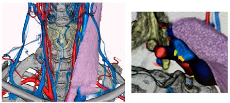 Figure 1 From Vagus Nerve Visualization Using Fused Images Of 3D CT