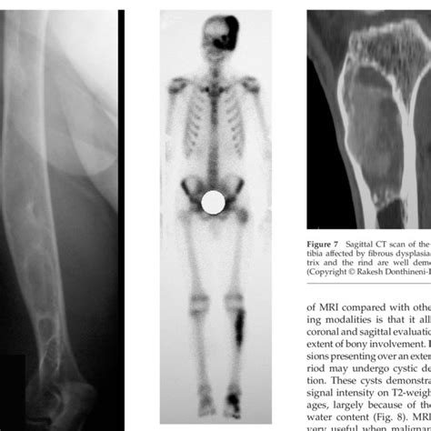 Fibrous Dysplasia Femur