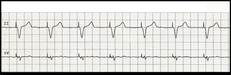 Float Nurse: EKG Rhythm Strip Quiz 100: Paced rhythms