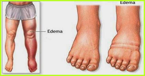 Edema And Its Types Overall Science