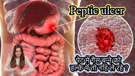 Peptic Ulcer Treatment पेट के घाव का इलाज Peptic Ulcer Kyu Hota H Youtube