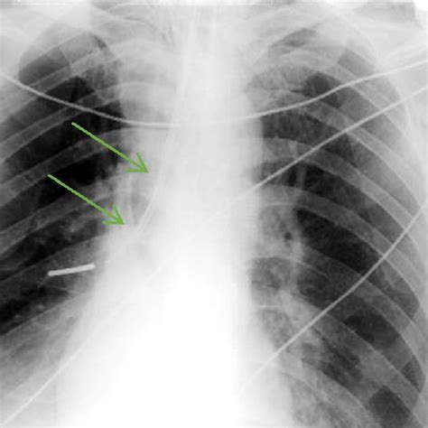 Chest X Ray Demonstrating Left Side Pneumothorax Download Scientific