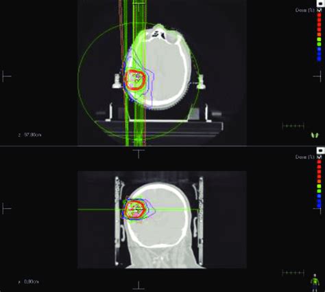 Hypofractionated Stereotactic Radiotherapy Treatment With Volumetric Download Scientific