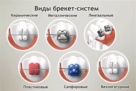 Брекет-система в ортодонтии: коррекция положения зубов и выравнивание ...