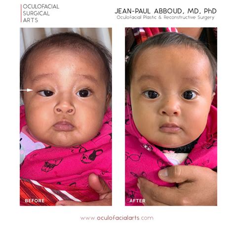 What is Congenital Ptosis (Eyelid Droop)?