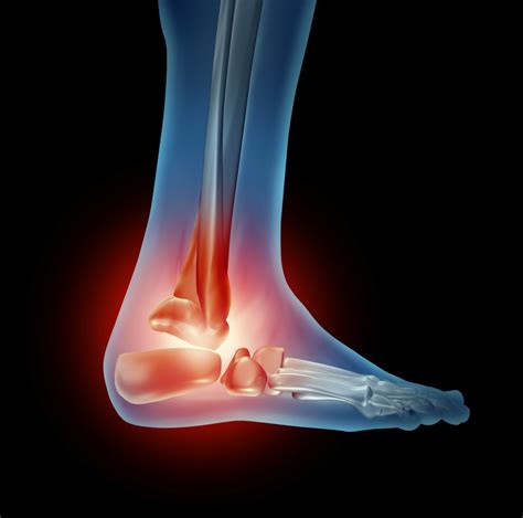 Stiffness of ankle Cause, Symptoms, Treatment, Exercise | Samarpan P