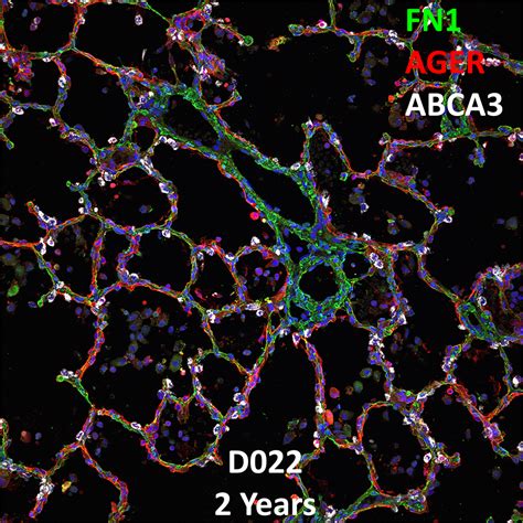 Year Old Human Lung Immunofluorescence And Confocal Imaging Donor