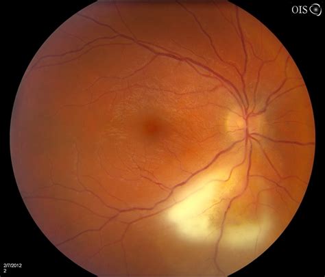 Vitreous Hemorrhage Symptoms - VRSN