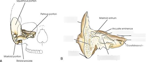 Coronal Section Through Mastoid And Petrous Portions Of Temporal Bone