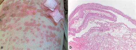 Figure From Drug Induced Linear Iga Bullous Dermatosis A Case Report